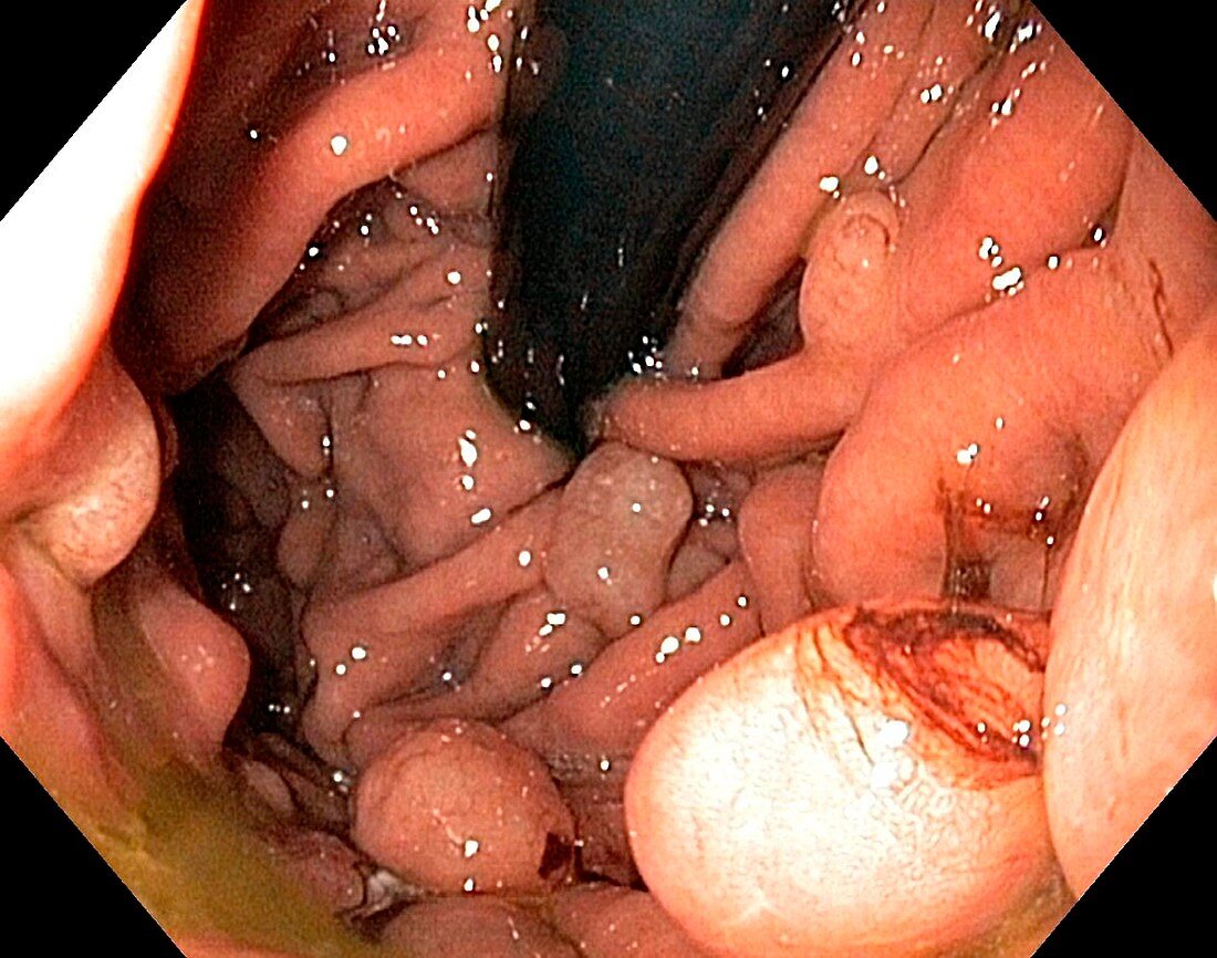 Hyperplastic polyps in the stomach