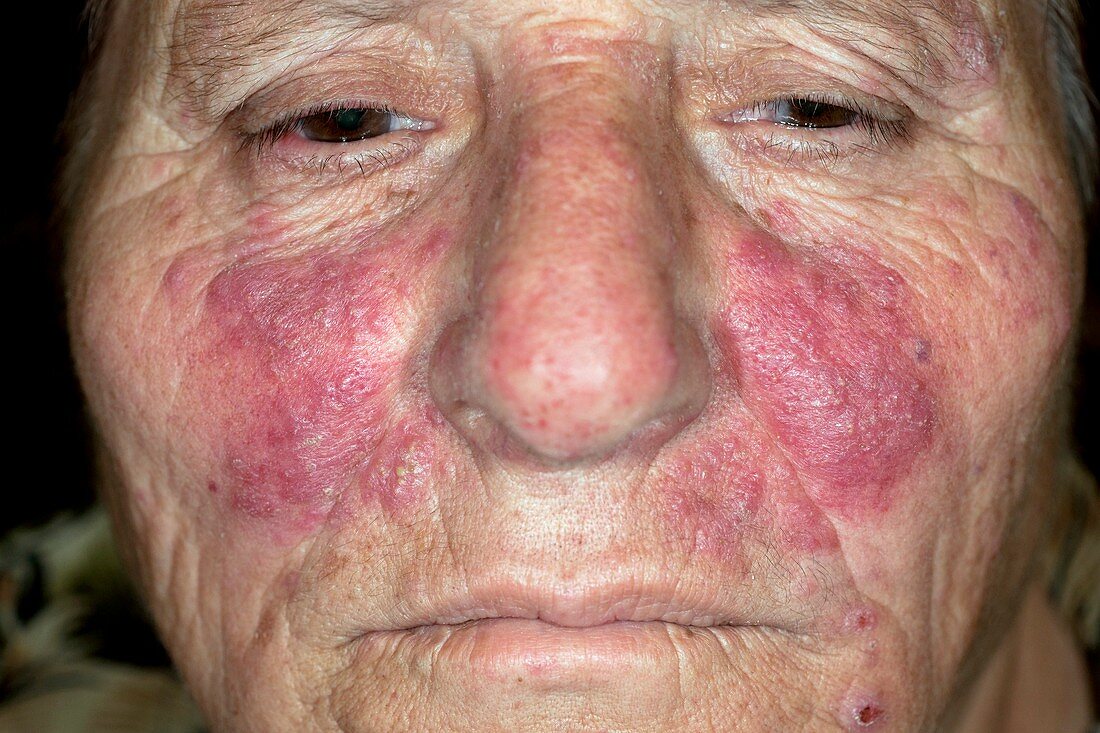 Acne rosacea on the face