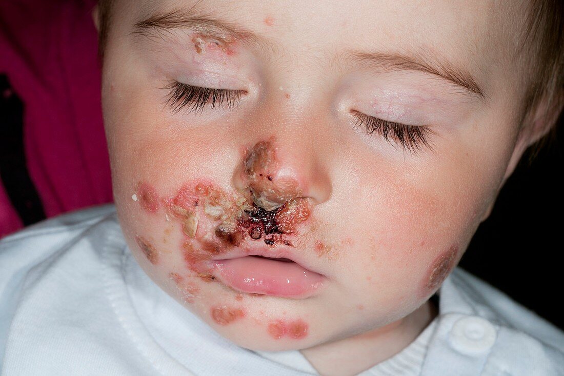 Impetigo skin infection in an infant