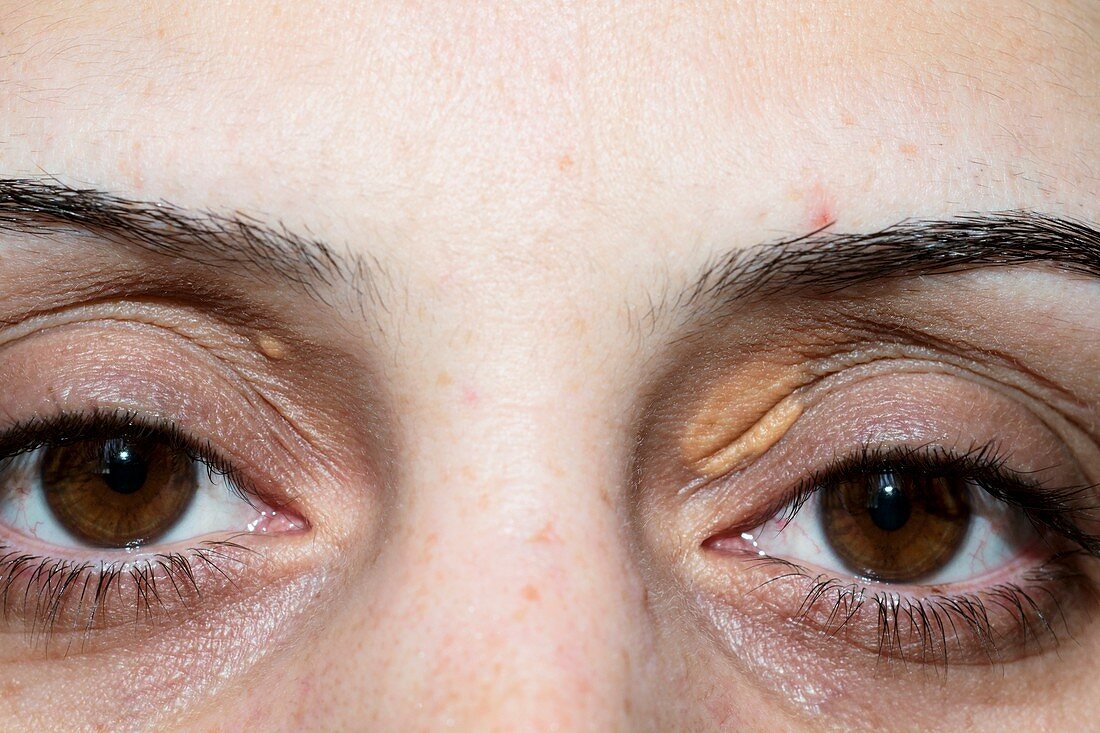 Xanthelasma on the eyelid