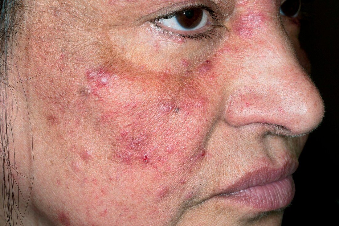 Acne rosacea on the face