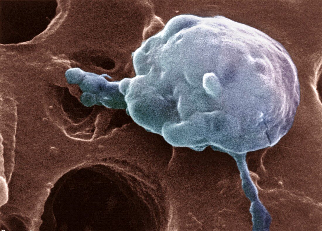 Cancer cell attacked by macrophages,SEM