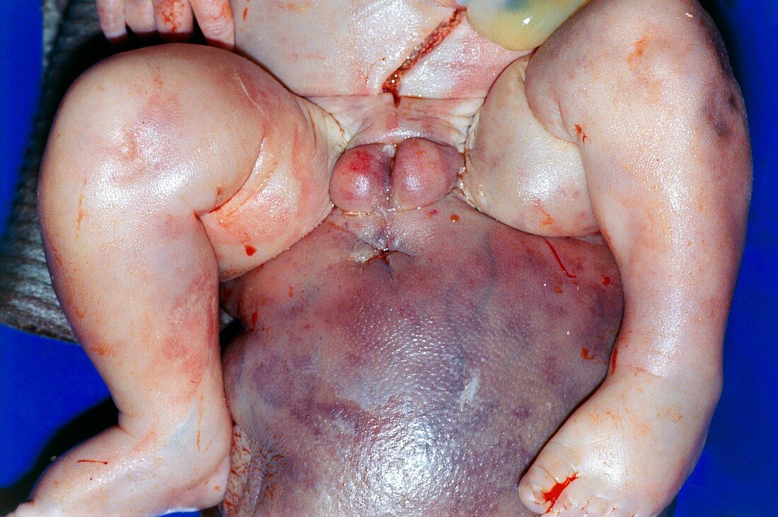 Congenital teratoma