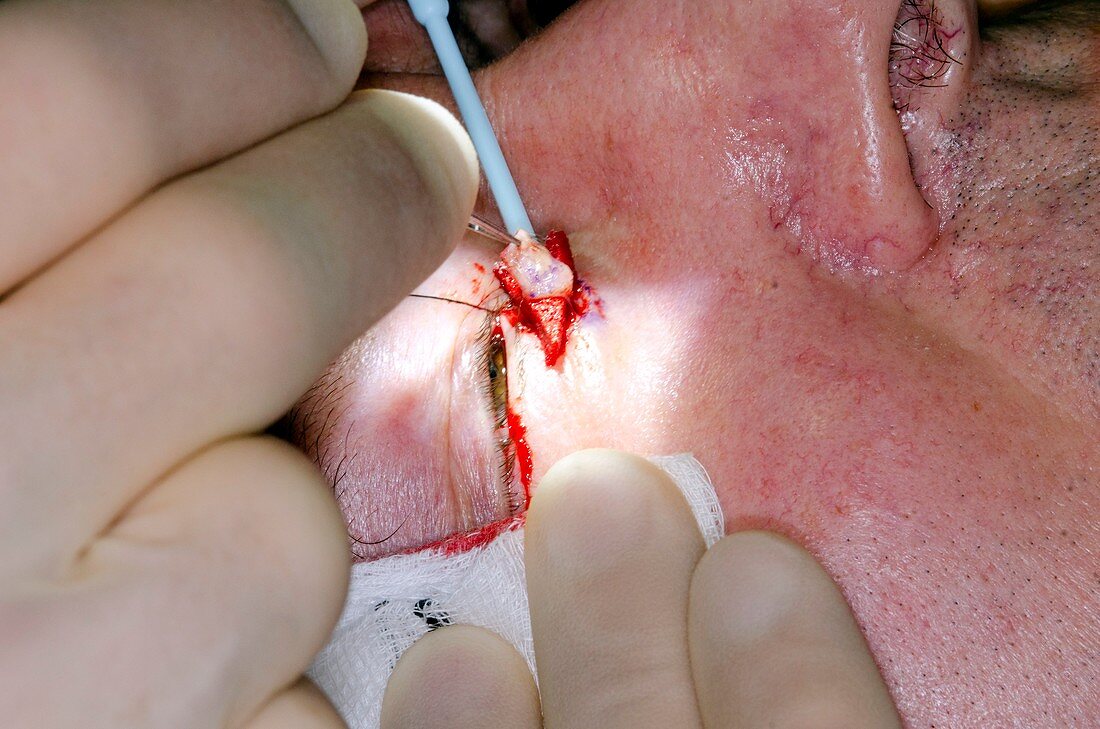 Excision of a basal cell skin cancer