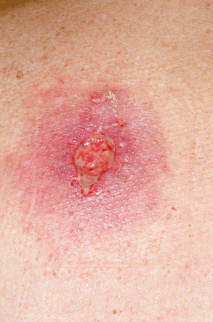Infection after skin cancer removal
