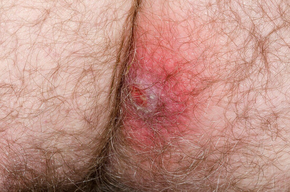 Abscess on the buttock