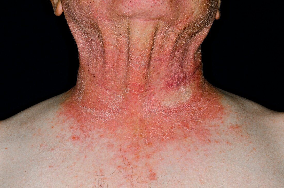 Photosensitive rash on the neck