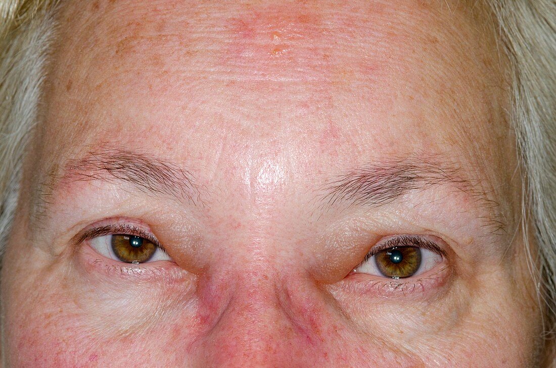 Facial oedema after insect bites