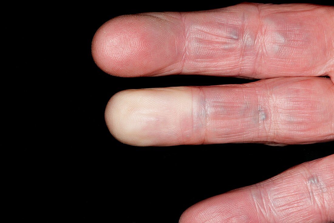 Raynaud's phenomenon of the finger