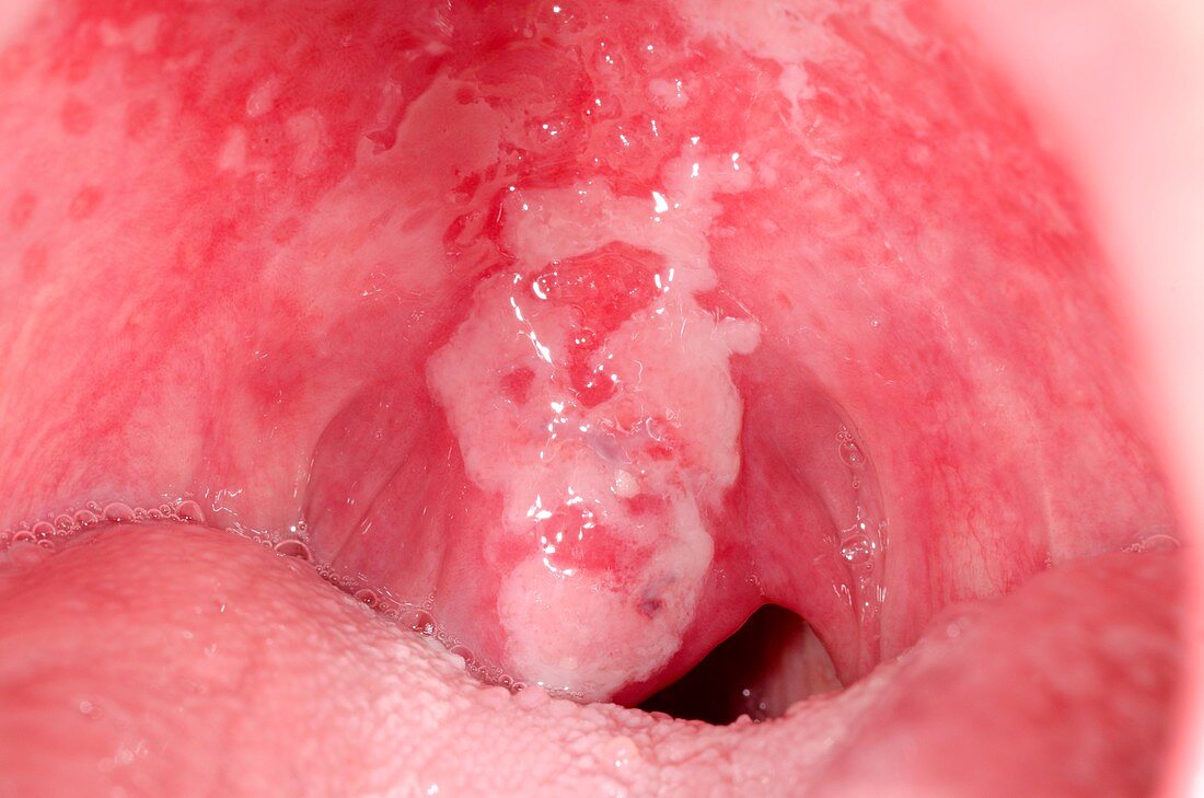 Lichen planus in the mouth