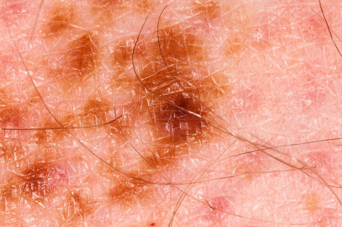 Junctional naevus (mole) on the skin