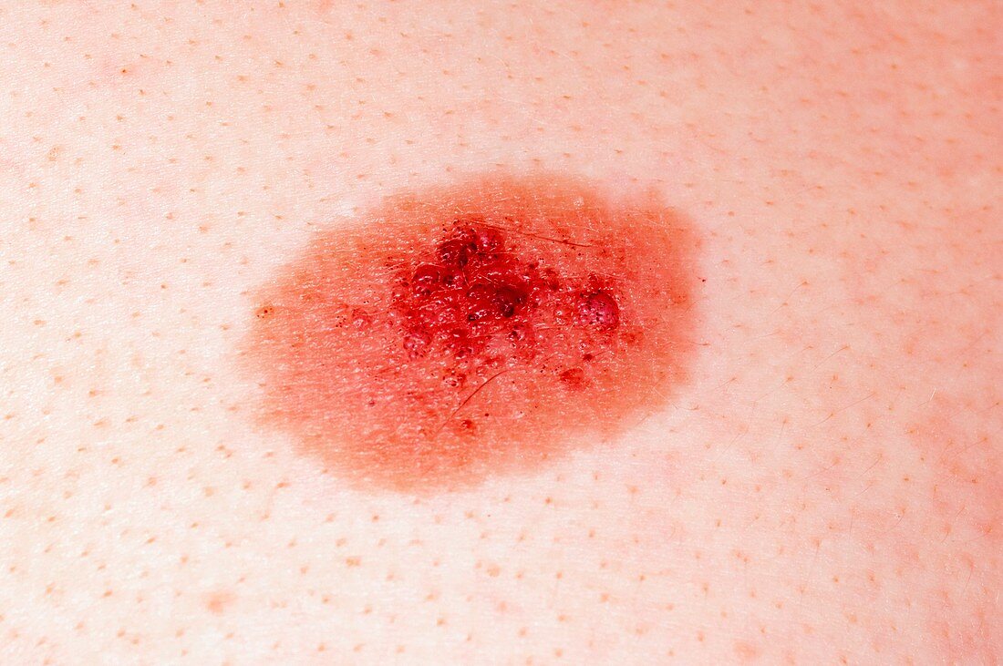 Melanocytic naevus (mole) on the skin