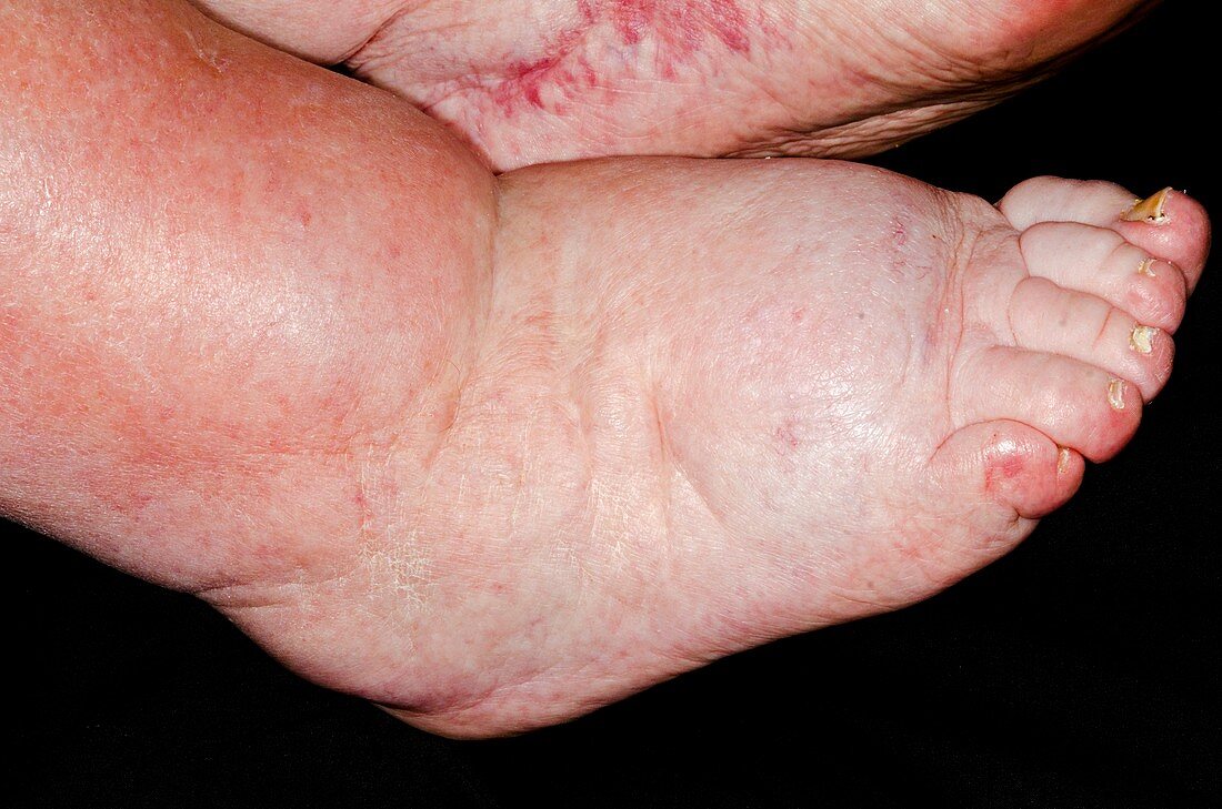 Oedema of the lower limbs