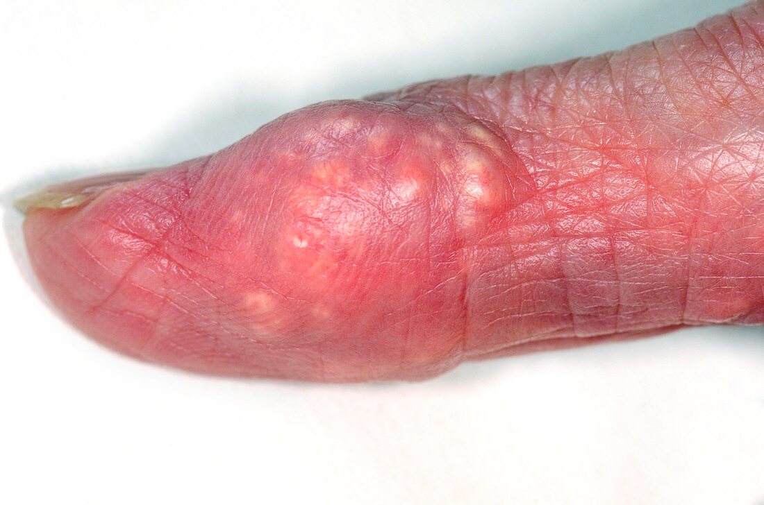 Gouty tophus on the finger