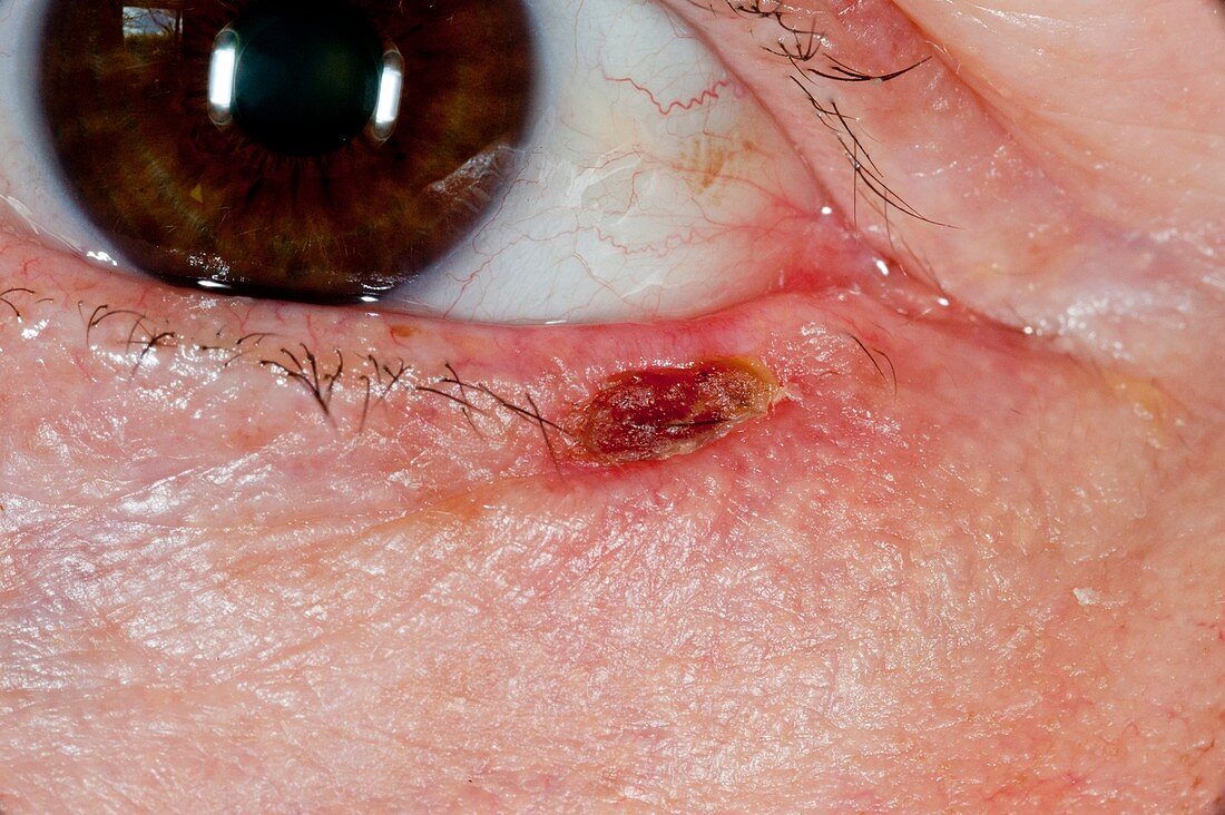 Cancer removal scar on the eyelid