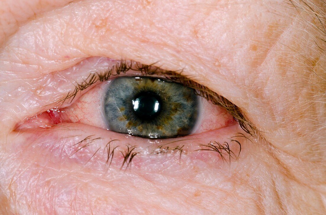 Herpes simplex eye infection