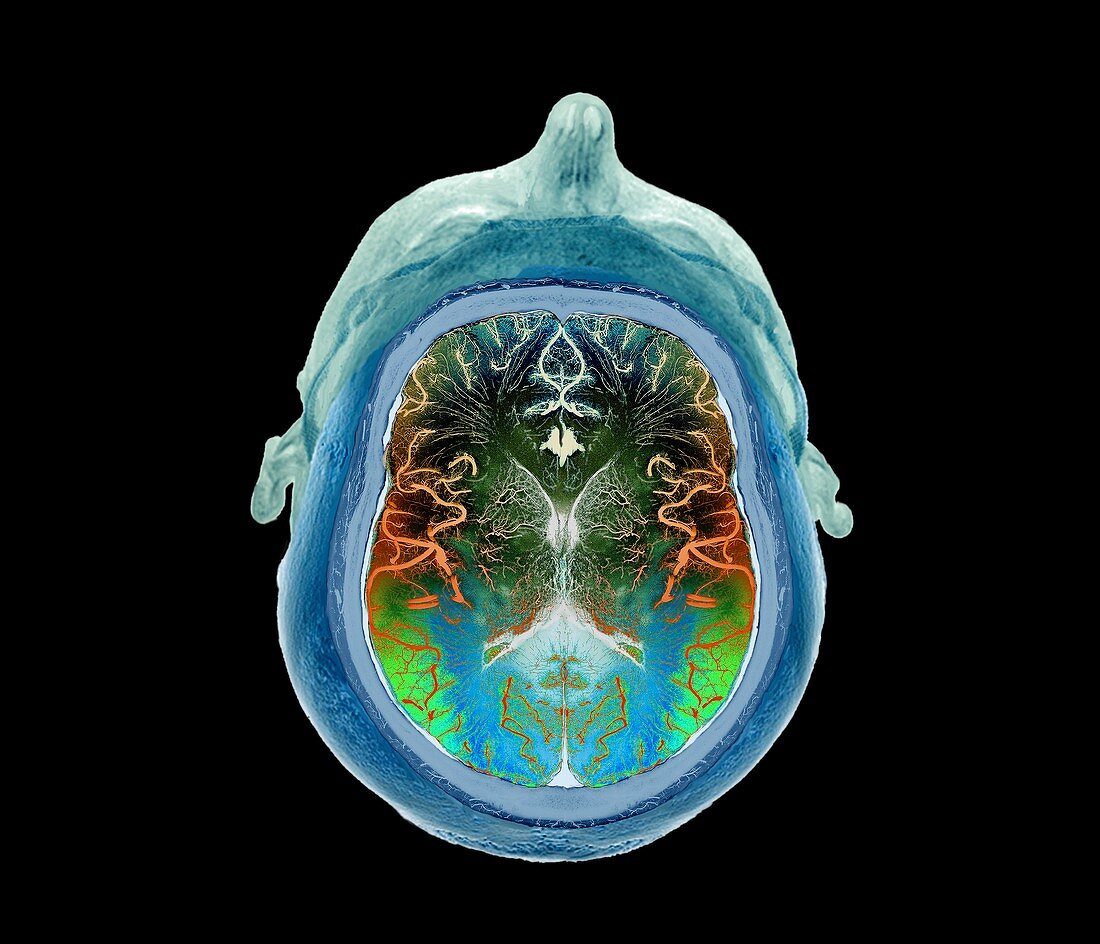Normal brain,3D CT angiogram