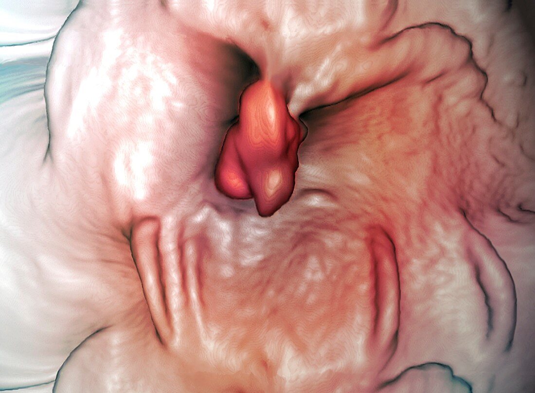 Intestinal polyp,virtual colonoscopy