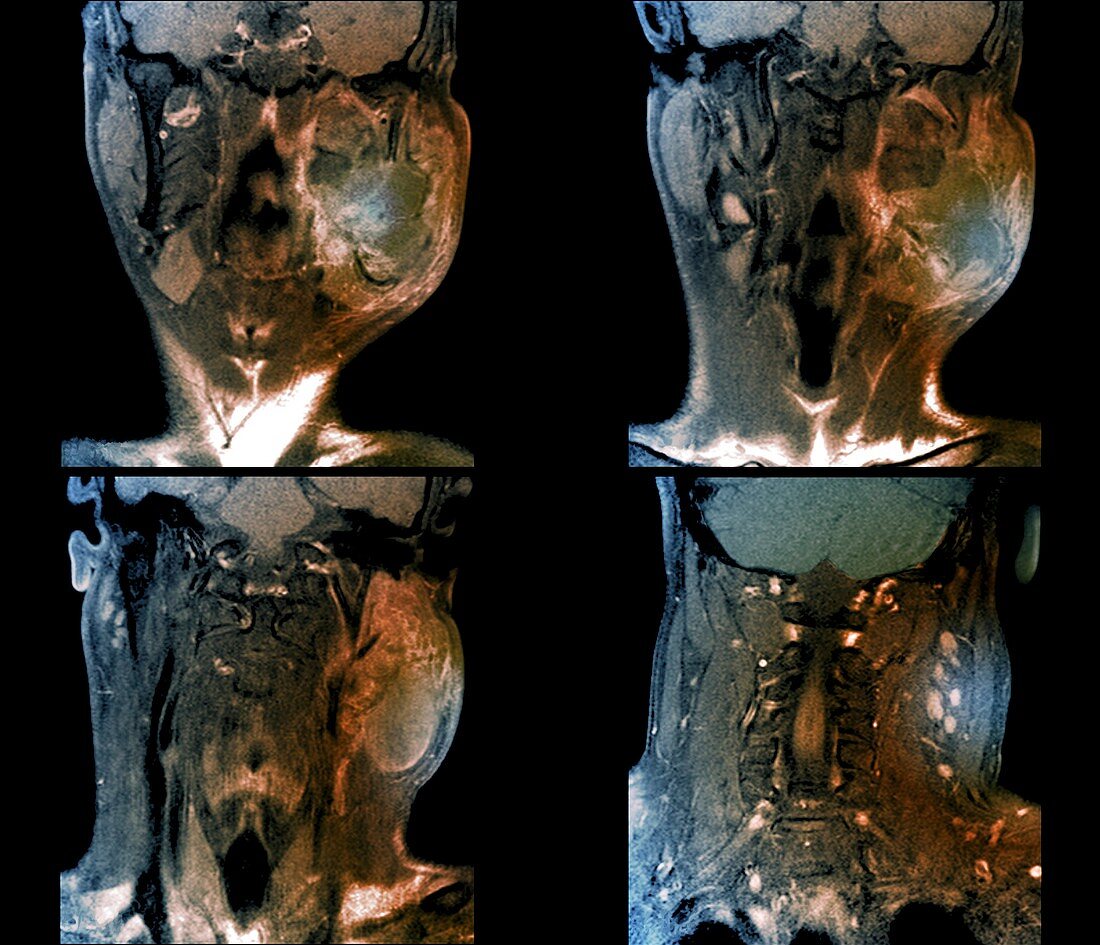 Mouth cancer,MRI scans