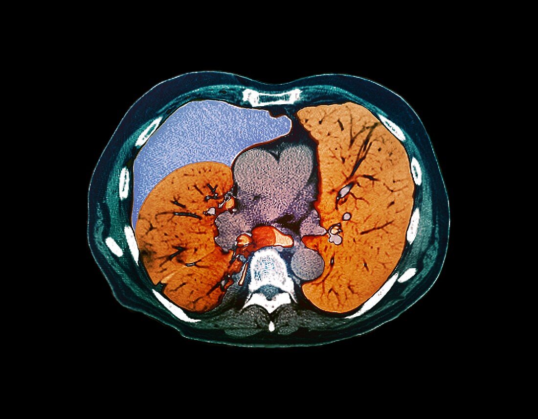Pneumothorax,CT scan