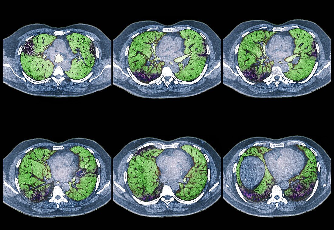 Interstitial lung disease,CT scan