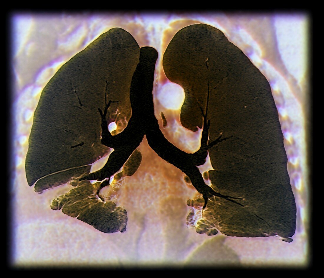 Kaposi's sarcoma of the lung,CT scan