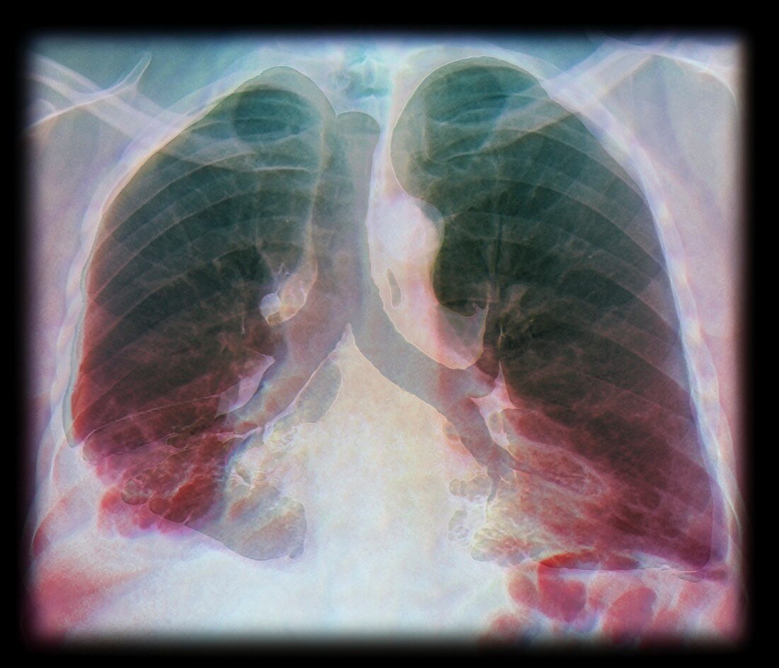 Kaposi's sarcoma of the lung,CT scan