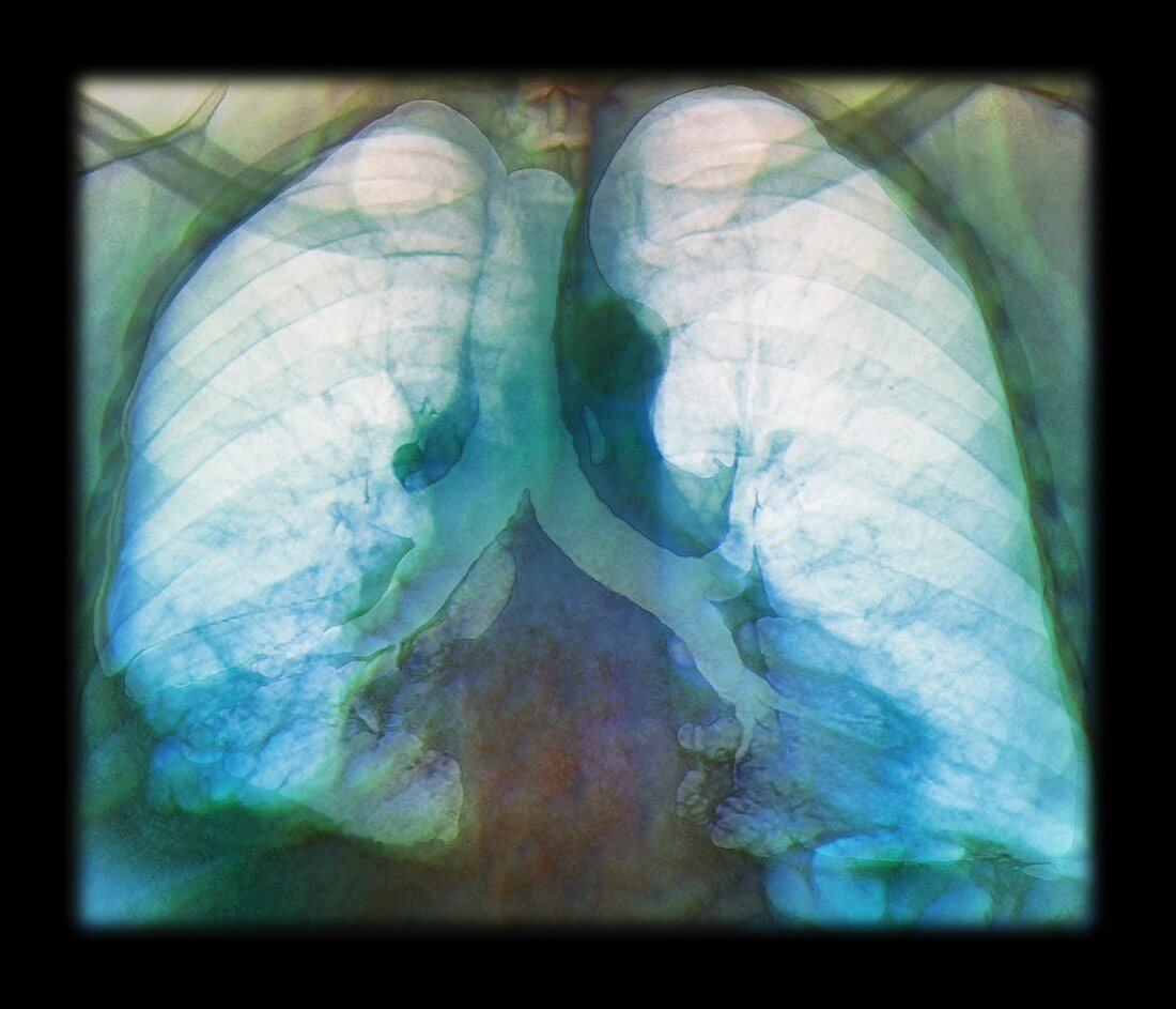 Kaposi's sarcoma of the lung,CT scan