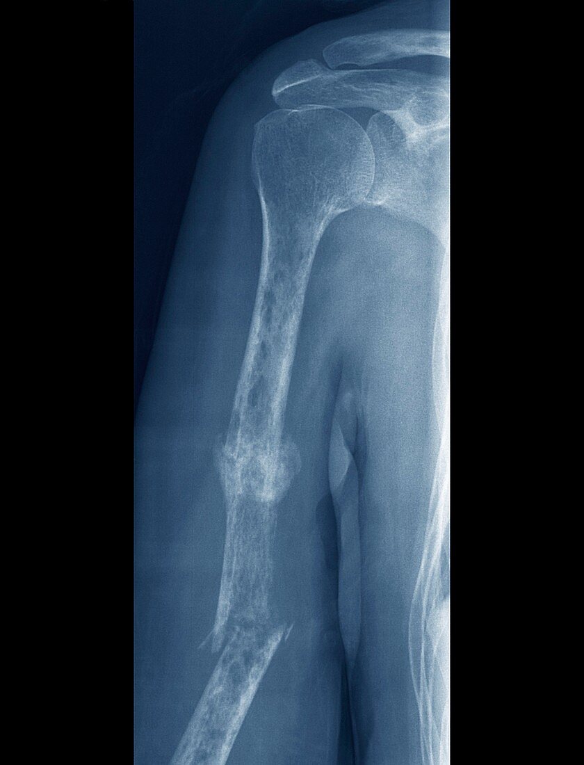 Fractures and bone cancer,X-ray