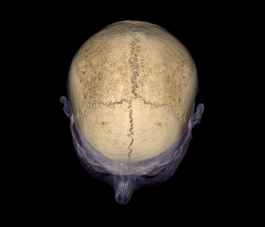 Skull sutures,3D CT scan
