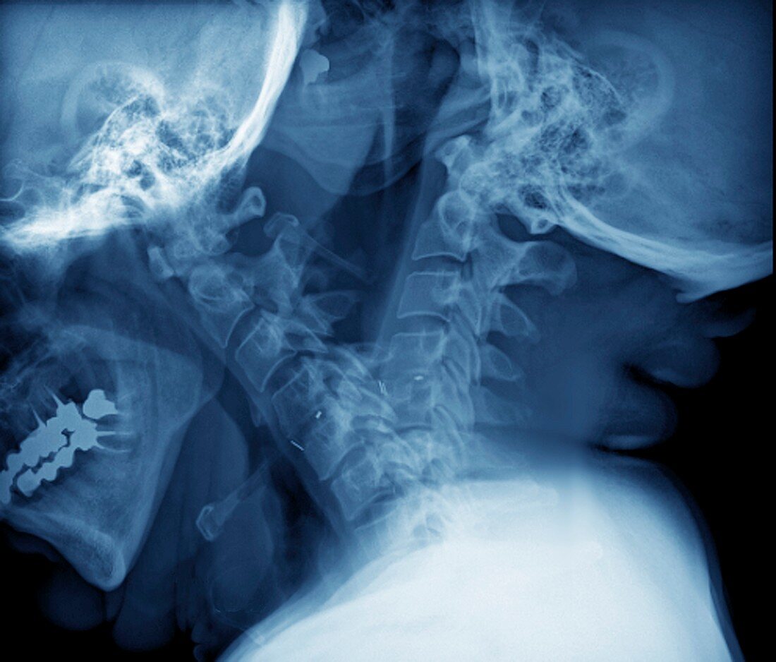 Spine fixation,X-ray
