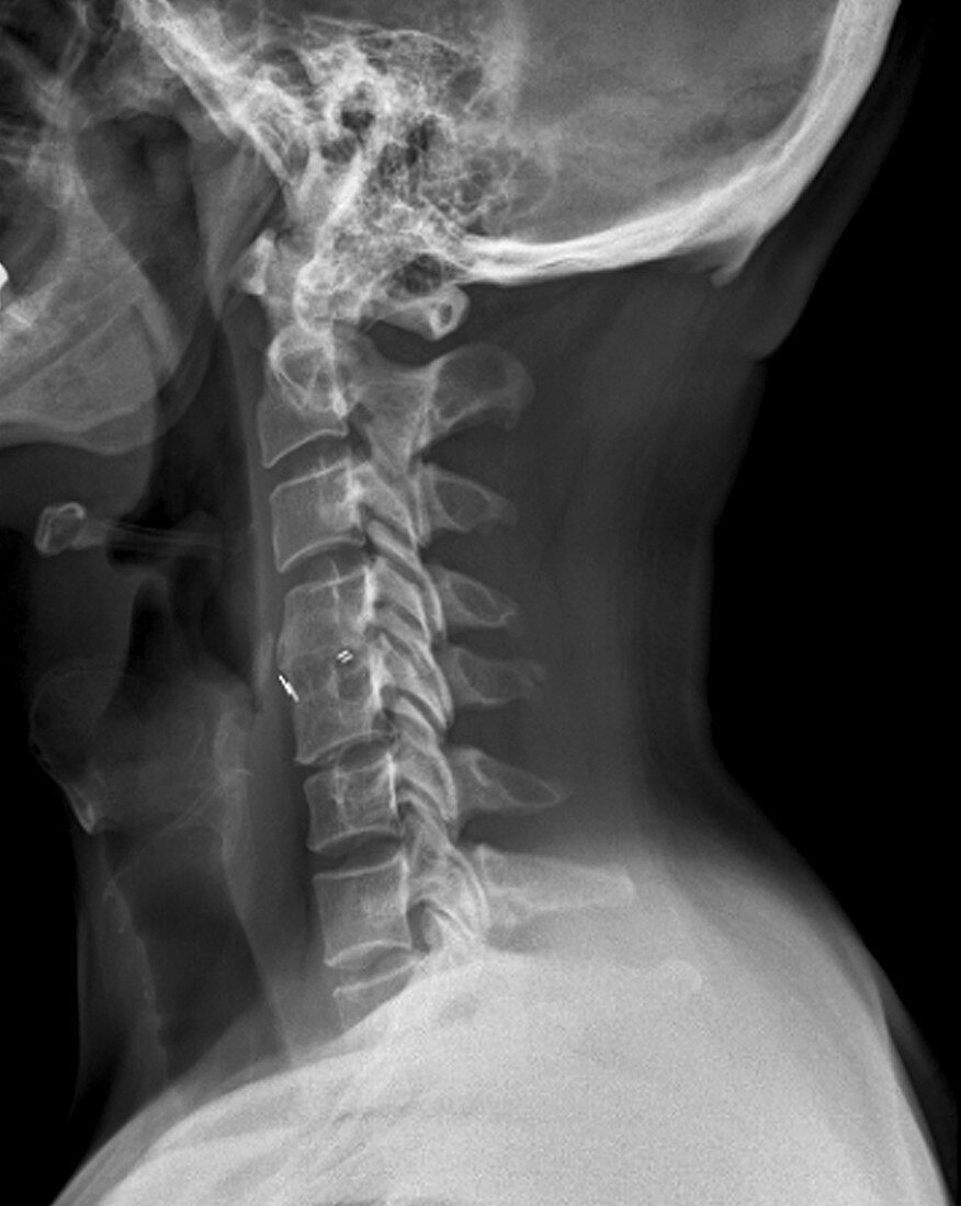 Spine fixation,X-ray