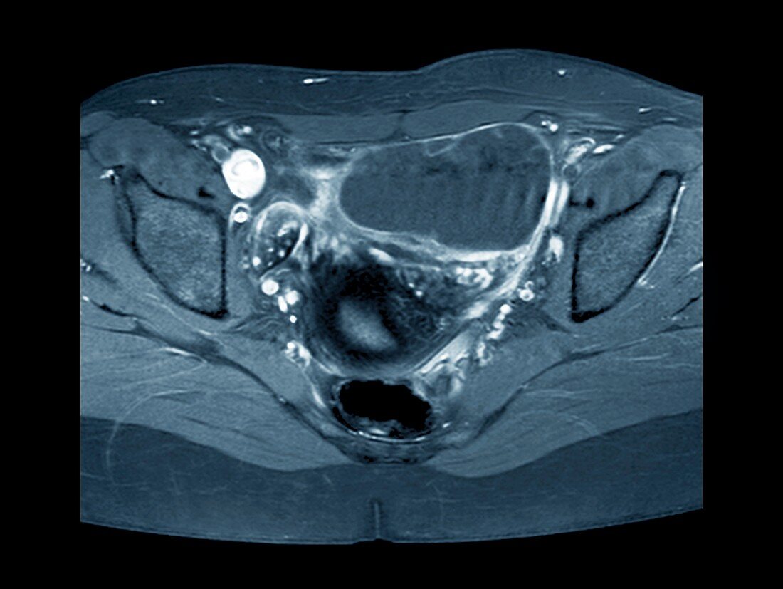 Ovarian cyst,X-ray