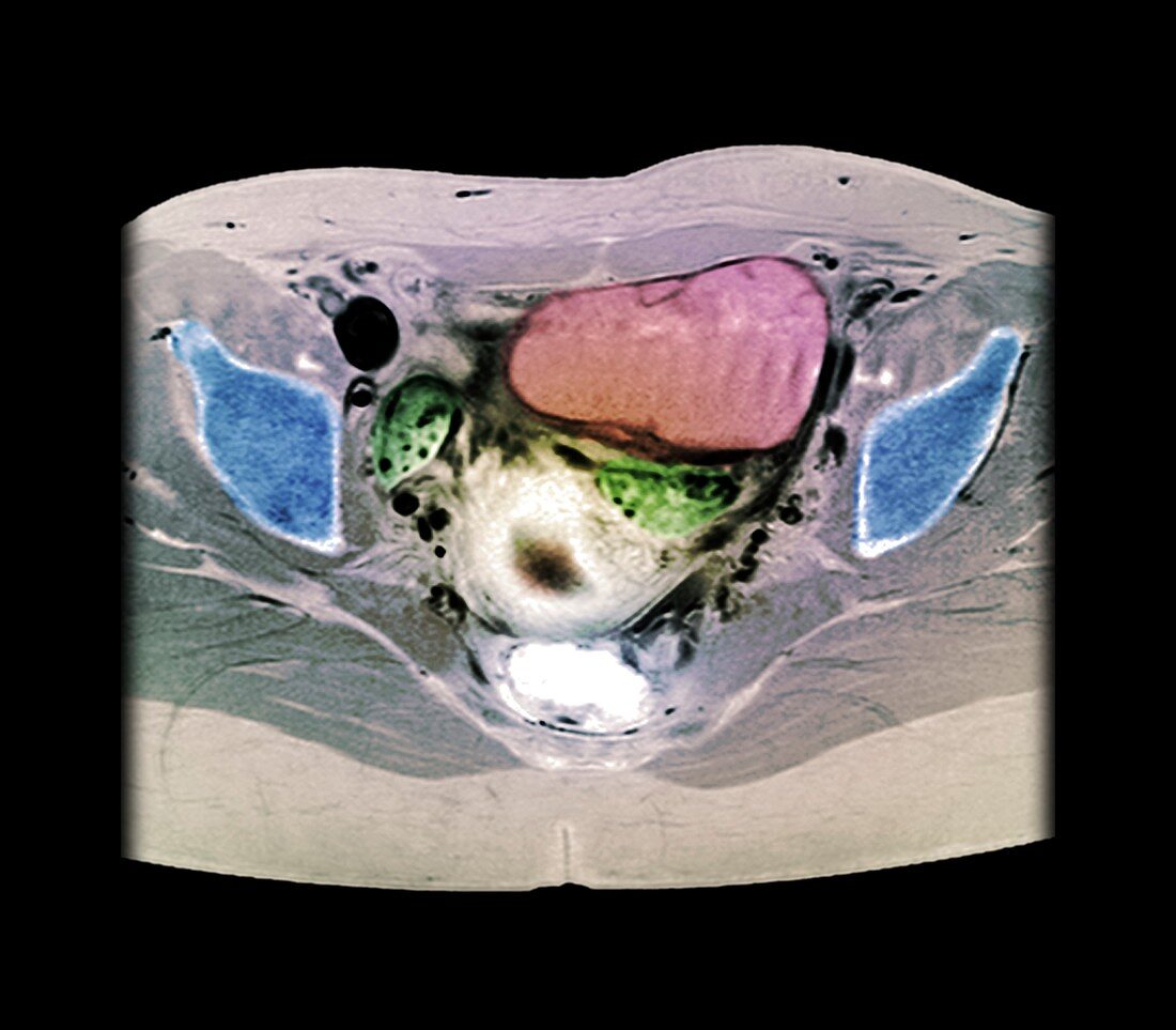 Ovarian cyst,X-ray