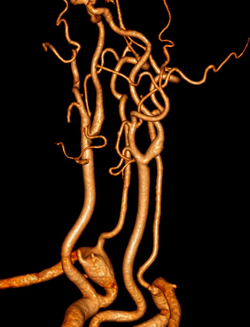 Neck blood vessels in stroke patient
