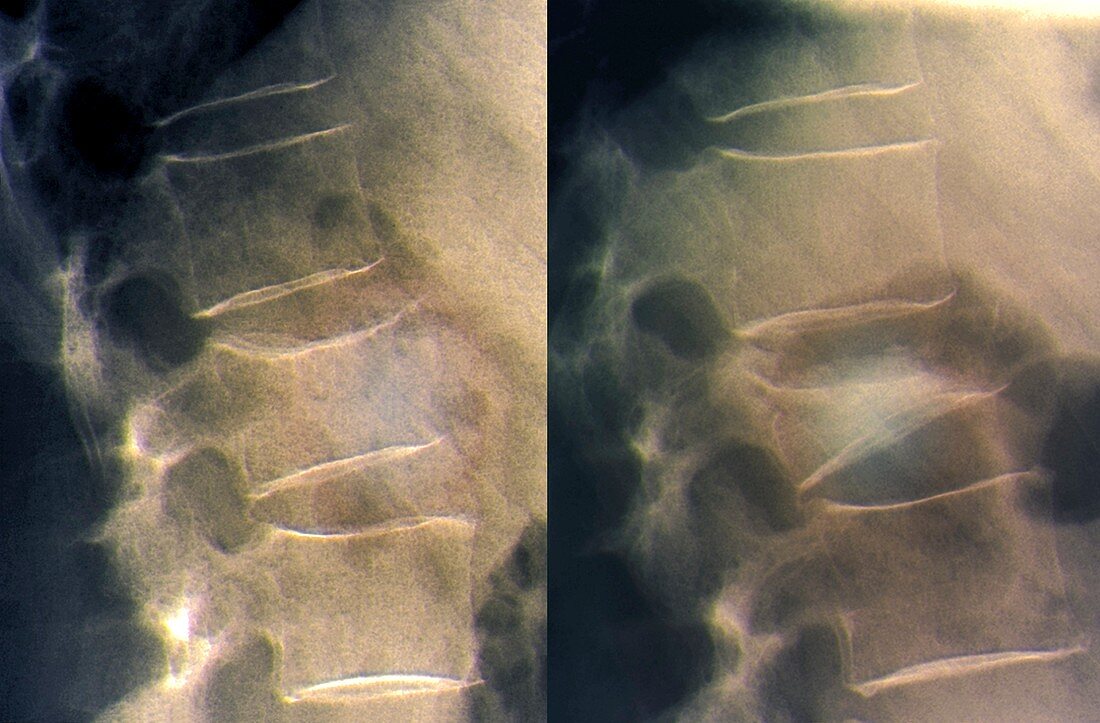 Spine fracture in osteoporosis,X-ray