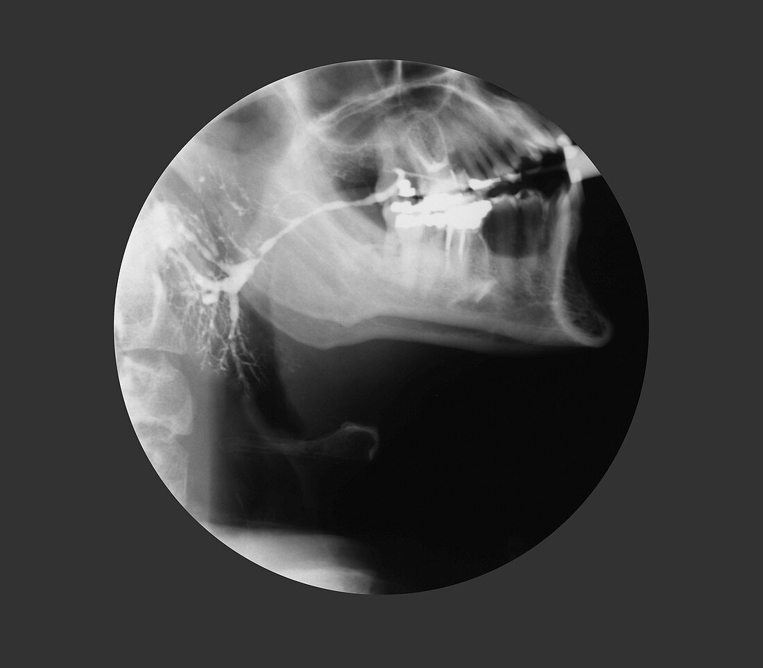 Inflamed salivary gland,X-ray
