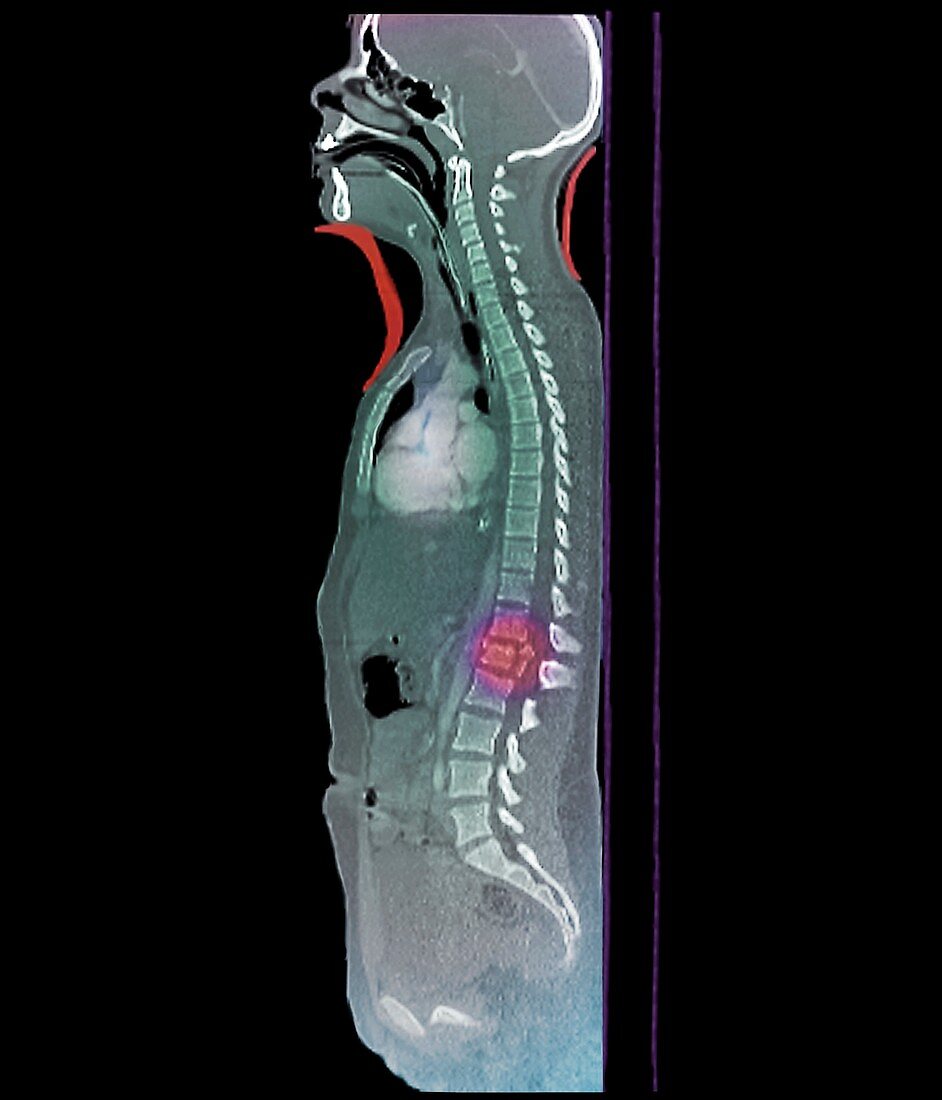 Spine fracture,CT scan