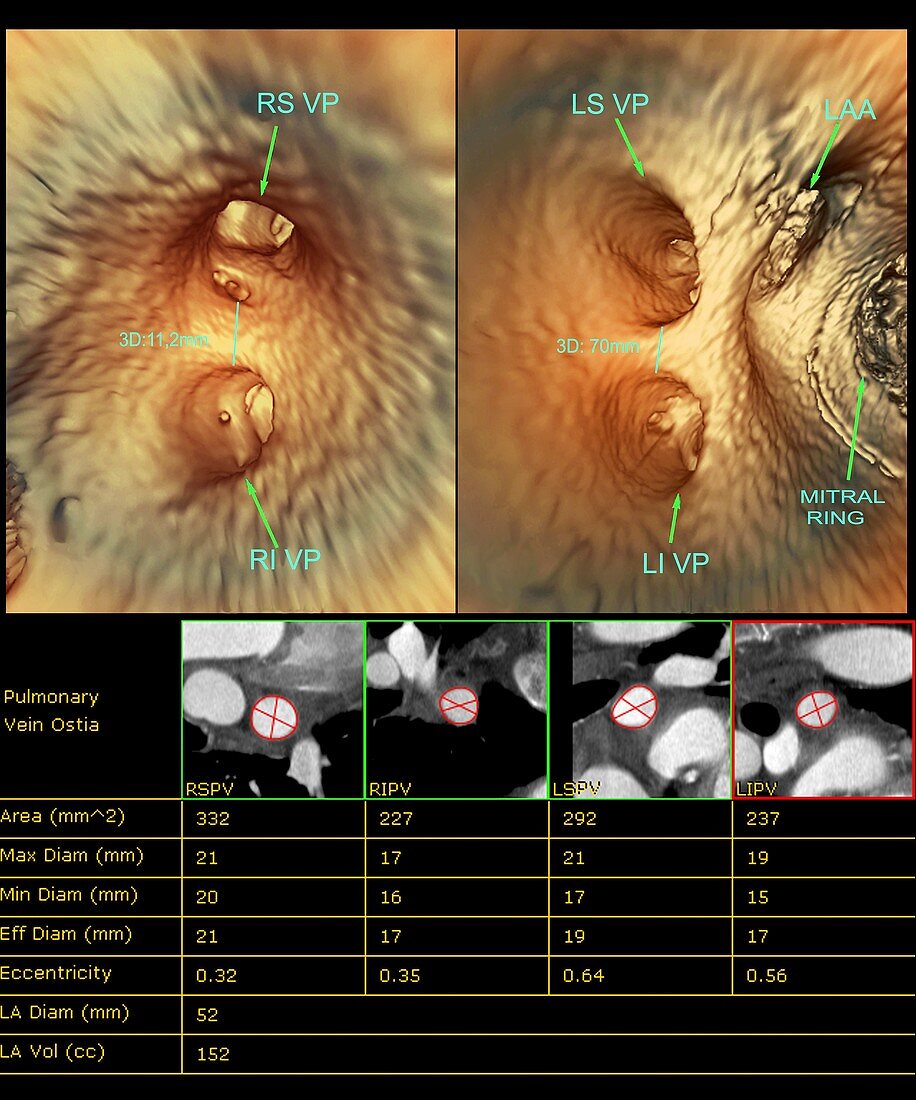 Internal heart anatomy,3D CT scan