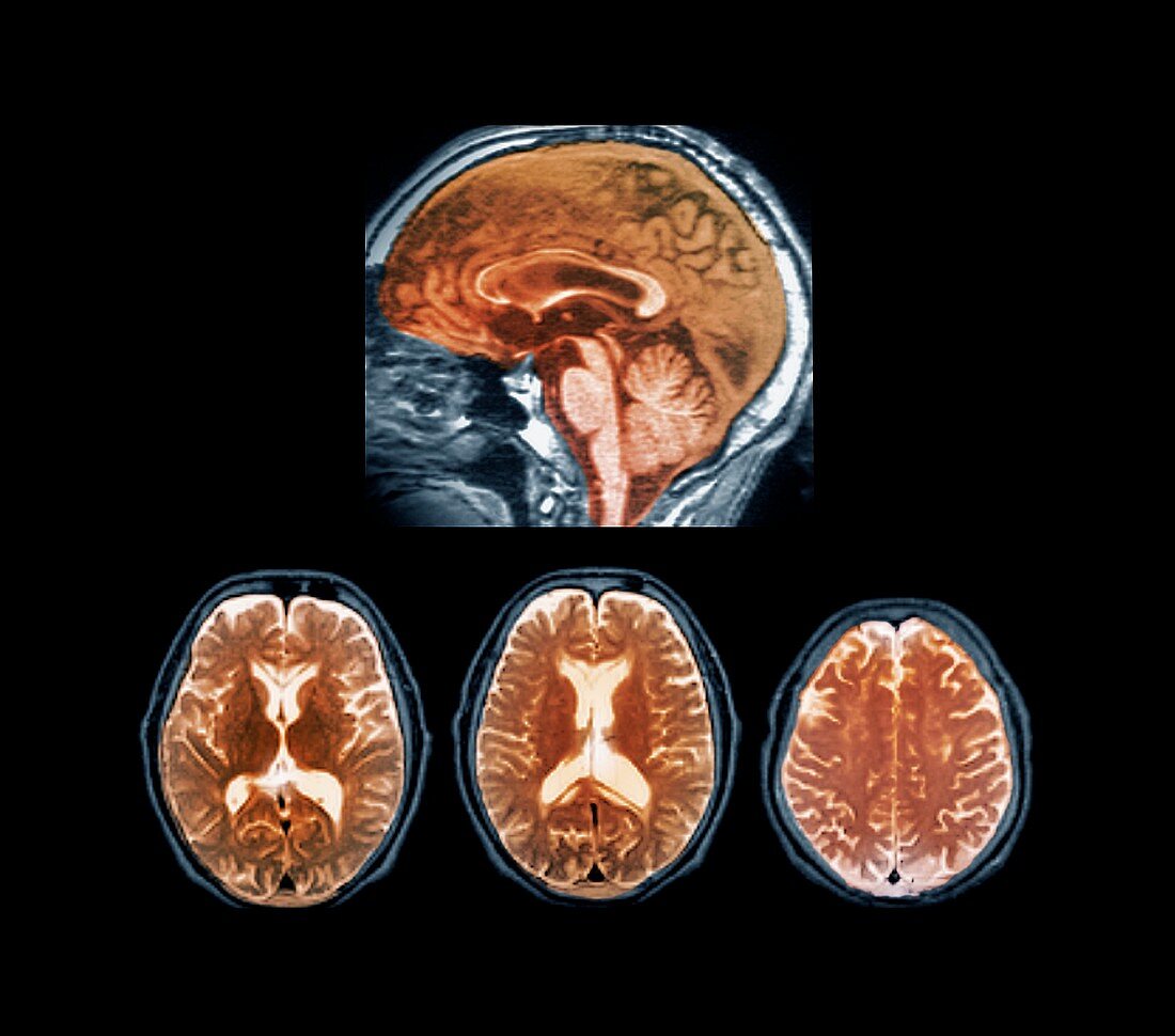 Marchiafava-Bignami disease,MRI scans