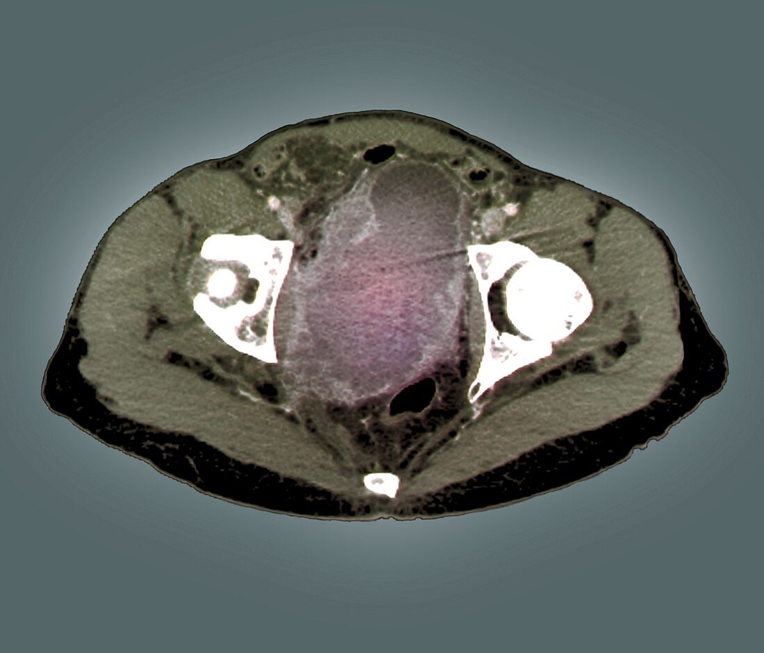 Bladder cancer,MRI scan