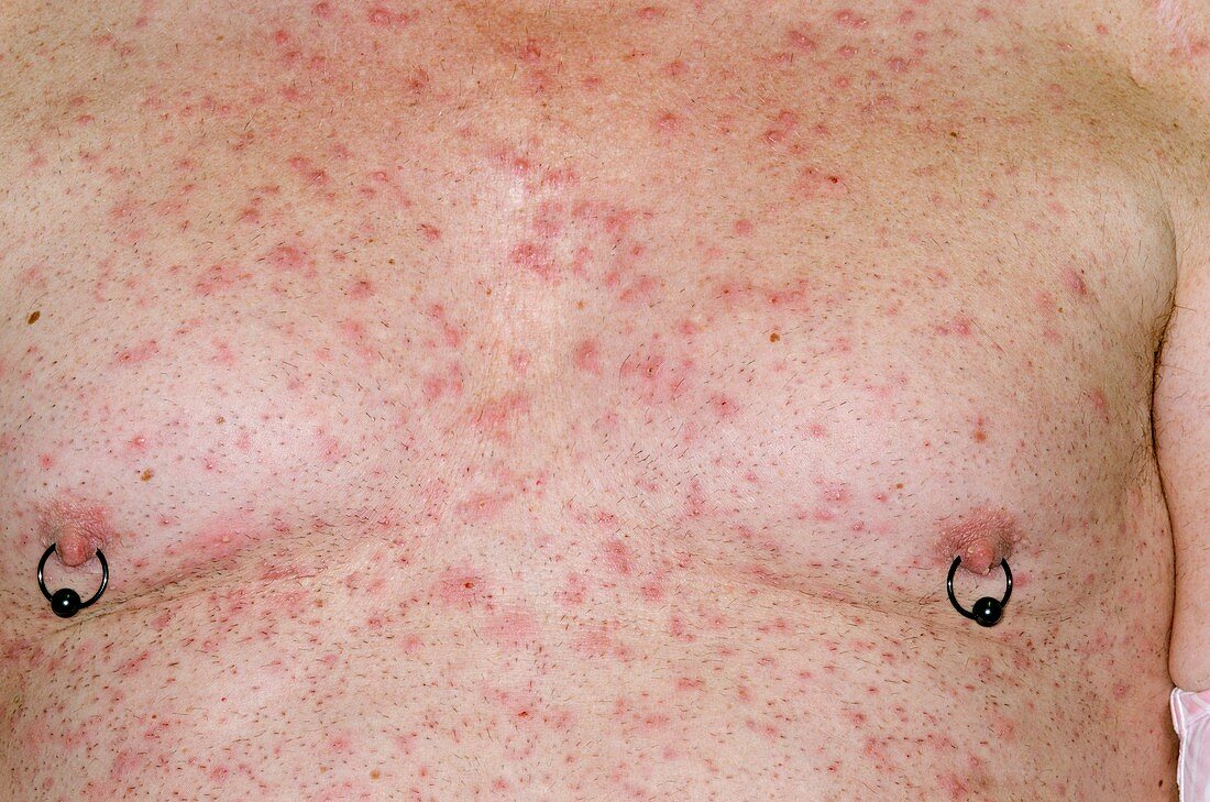 Folliculitis on the chest