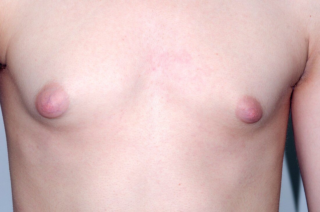 Gynaecomastia,male breast