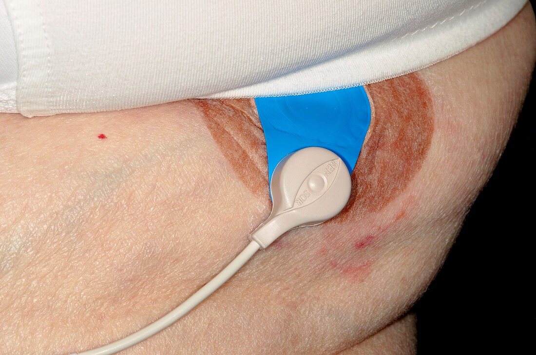Novacor heart monitor on patient