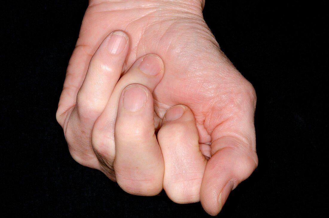 Osteoarthritis of the hand