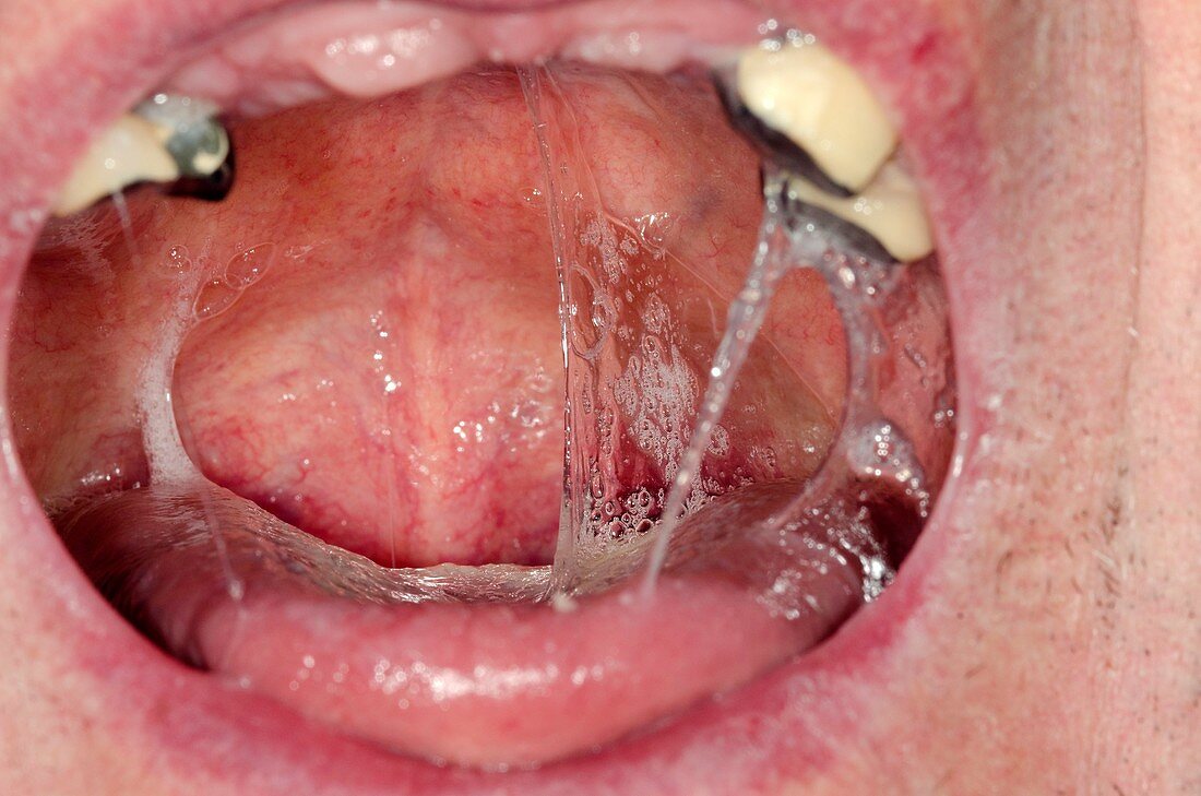 Mucous in mouth after radiotherapy