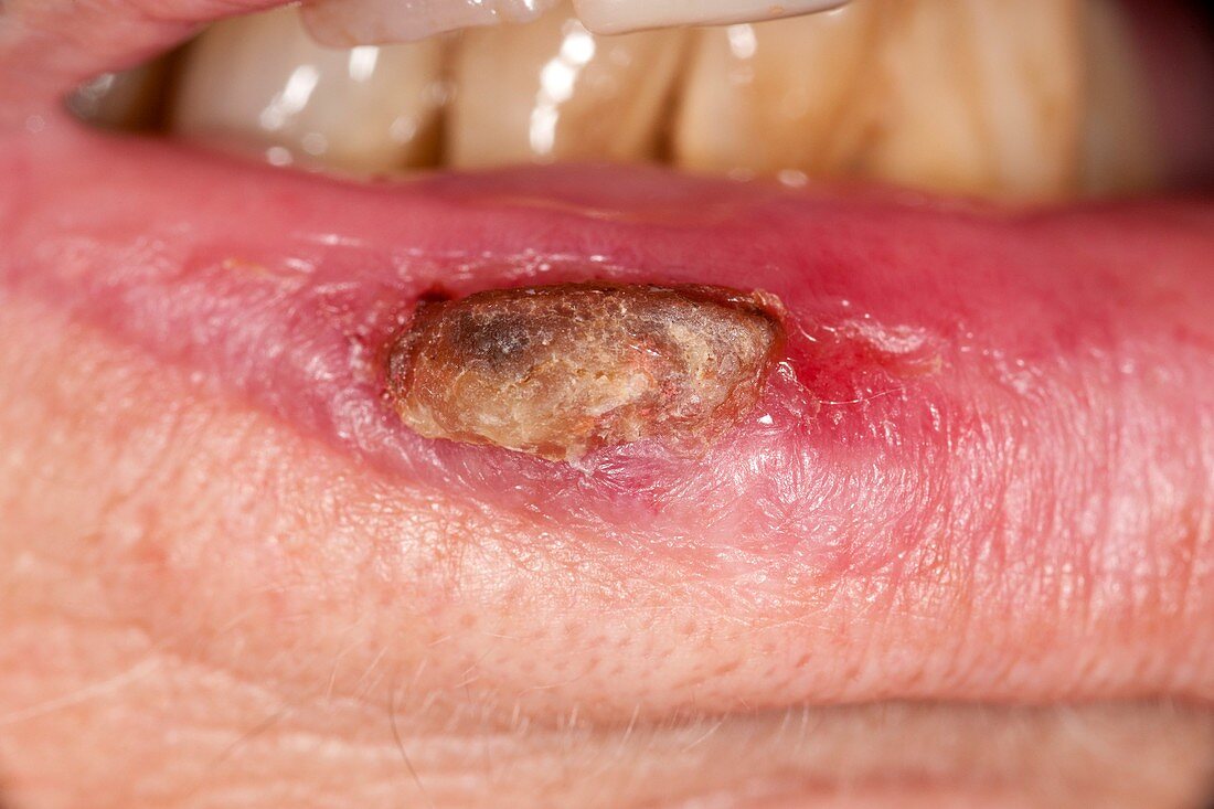 Squamous cell skin cancer on the lip