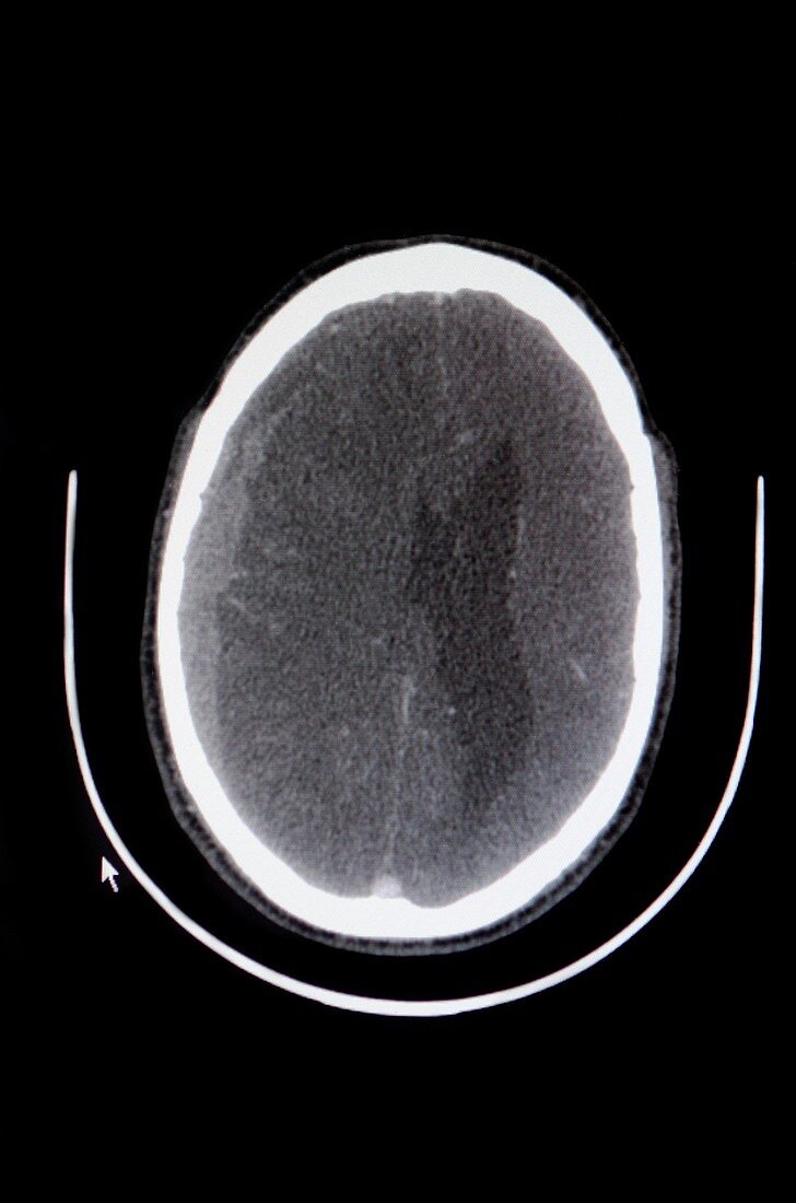 Subdural haematoma,CT scan