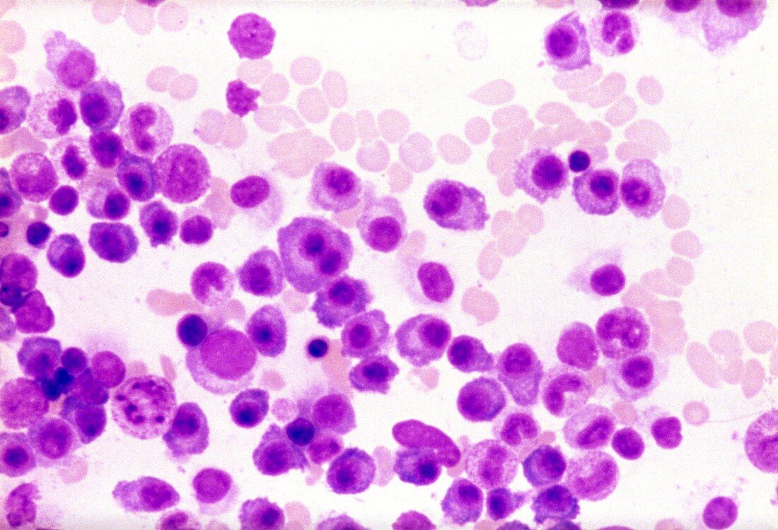 Myeloma blood cancer,light micrograph