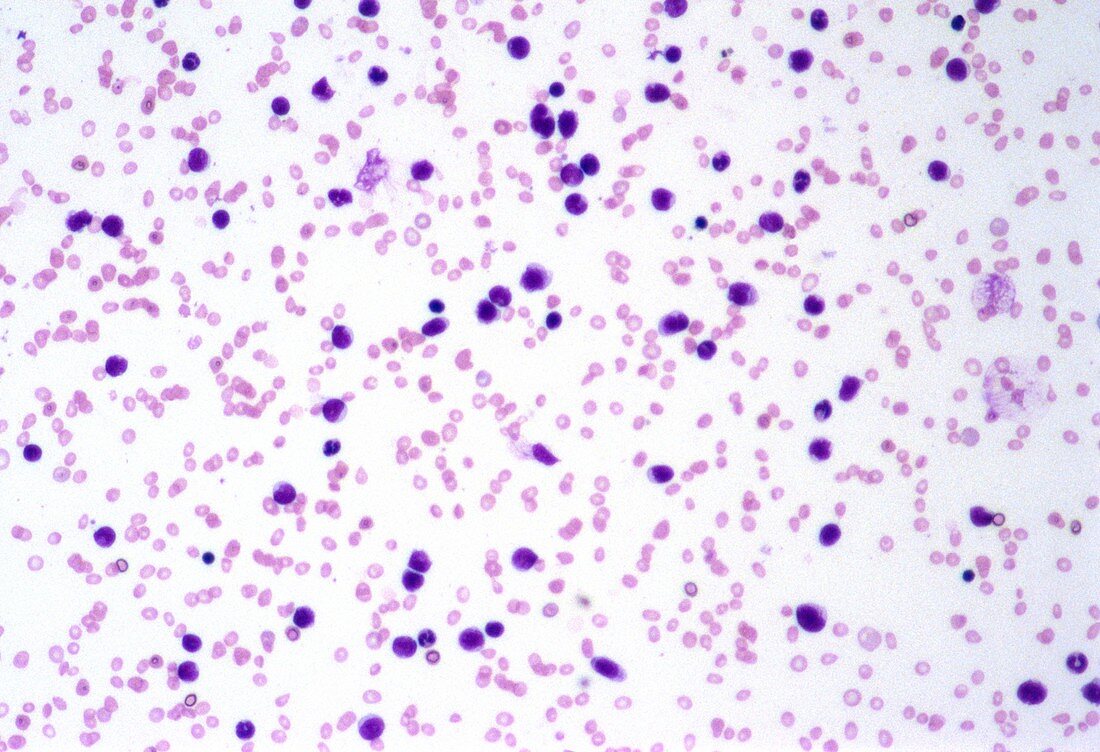 Acute lymphocytic leukaemia,micrograph